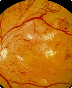 Donate for Retinopathy Treatment